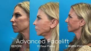 Dynamic Photos Showing Before Facelift - 15 days post Facelift & Final Results