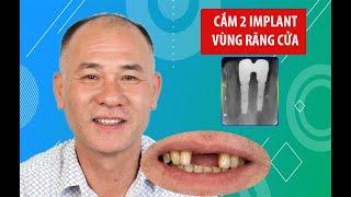 Trồng implant 2 răng cửa Chú thấy mình đã đi đúng đường đạt đúng mục tiêu