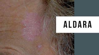 6 Week Aldara Skin Cancer Treatment Update