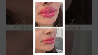#lip filler injection#Russian lip filler injection#ژل_لب_روسی