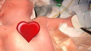 Lahir Dengan Jantung Berdetak Di Luar Tubuh Dokter Menunggu 9 Minggu Untuk Lakukan Ini
