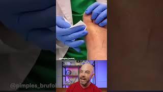 Foot Cyst Pop #dermreacts #satisfying #doctorreacts #cystpop