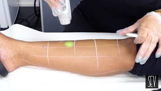 LEG HAIR REMOVAL  SEV LASER