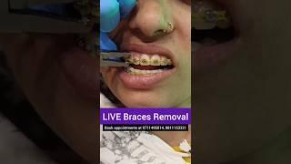 LIVE Braces Removal- Debonding Dr. Srishti Bhatia #braces #teeth