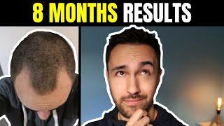 8 Month Update of my Hair Transplant