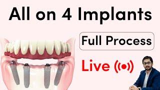 All on 4 Dental Implants  Live surgery at Seraphic Indore   फिक्स बत्तीसी के लिए Implant process