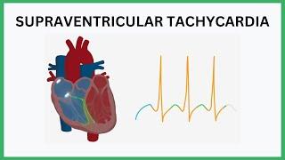 ECG 6 Supraventricular Tachycardia SVT