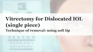 Vitrectomy for dislocated IOL single piece - Technique of removal using soft tip