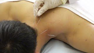 What You Need to Know About Acupuncture