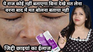 जाने 2% Kojic Acid Cream for Pigmentation के बारे मे   अब जिद्दी छाइयां को हटाना हुआ आसान