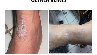 NEURODERMATITIS  Materi Kedokteran  Dermatologi