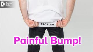 Painful bump on buttocks. Causes Symptoms & Treatment - Dr. Rajdeep Mysore  Doctors Circle