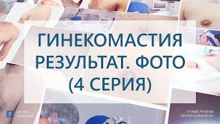 Гинекомастия у мужчин. Результат удаления истинной гинекомастии 2 типа 4 серия