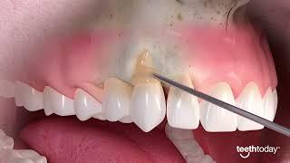 Mastering Gum Recession Treatment. Advance Dental Implant and TMJ Center