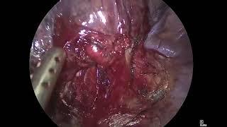 Asvide Right biportal VATS apical segmentectomy right S1