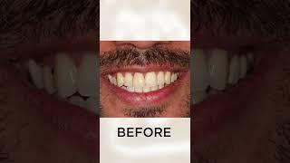 Smile Designing  #dentist #teethtreatment #smile #dentalcare #indore #implant #shorts #trending