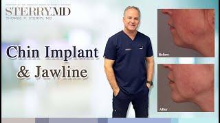 Will a Chin Implant Help Jawline & Facial Contouring? I NYC Plastic Surgeon Dr. Thomas P. Sterry