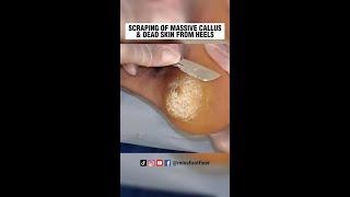 SCRAPING OF MASSIVE CALLUS & DEAD SKIN FROM HEELS 2023 BY MISS FOOT FIXER