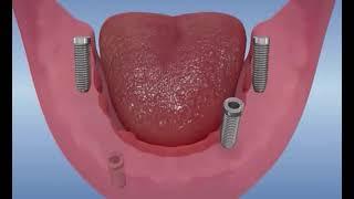 Toutes les dents sur 4 implants  All on four dentaire