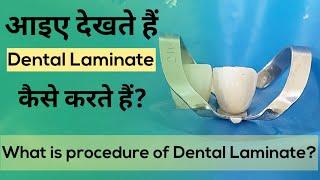 Dental Laminate l आइए देखते हैं  Dental Laminate कैसे करते हैं?