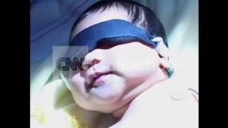 JAUNDICE TREATMENT