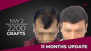 Grade 2 Baldness result - 2200 FUEDHT grafts 11-month update at Eugenix Hair Sciences India.