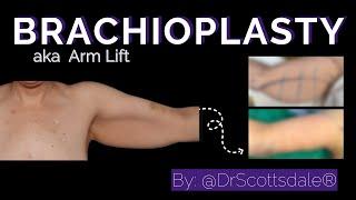 Brachioplasty aka ARM LIFT by @DrScottsdale®