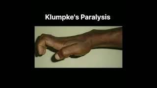 Klumpkes paralysis #short #doctor #shortsfeed #shortsvideo