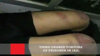 Third Degree Torture Of Prisoner In Jail