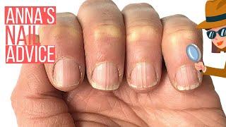 RIDGY NAILS? THE COSMETIC SOLUTION. ANNAS NAIL ADVICE