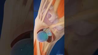 Ganglion Cyst Removal