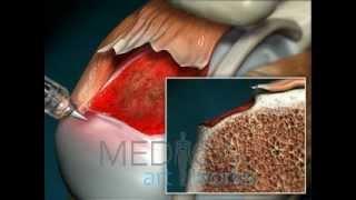 3D Medical Animation   Arthroscopic repair with anchors and sutures of rotator cuff tear