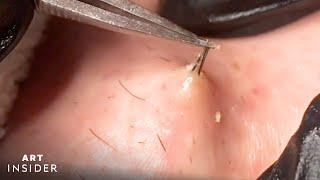 How Ingrown Hairs Are Removed  Art Insider