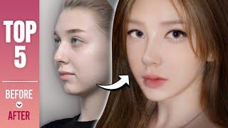 TOP5 Best Transformations at NANA l Plastic Surgery in Korea