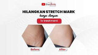 NO MORE WORRIES ABOUT STRETCH MARK  #StretchMark #Therapy #fyp