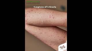 Natural Urticaria Relief Ayurvedic Remedies for Healthy Itch-Free Skin 