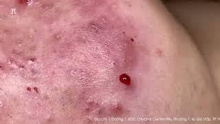 Big Cystic Acne Blackheads Extraction Blackheads & Milia Whiteheads Removal Pimple Popping