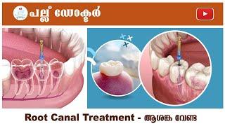 റൂട്ട് കനാൽ ട്രീറ്റ്മെന്റ് - ആശങ്ക വേണ്ട  Root Canal Treatment