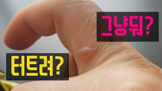 화상 물집 터트려야 빨리 낫는다 - 3일 치료 과정