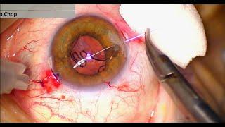 Minimally Invasive Surgery For Dislocated Intraocular Lens The Cupid Fixation step-by-step