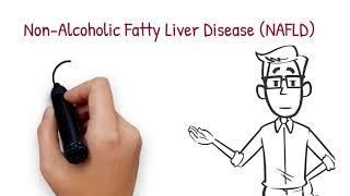 Non-alcoholic fatty liver disease NAFLD—are you at risk?