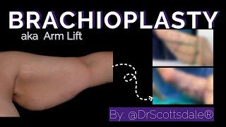 Brachioplasty aka ARM LIFT by @DrScottsdale