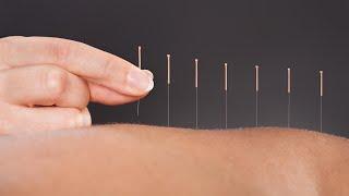 The Science Behind How Acupuncture Helps Relieve Pain A Doctor Of Chinese Medicine Explains