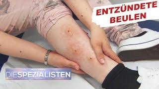 Beulen an den Beinen Parasitenbefall?  Auf Streife - Die Spezialisten  SAT.1 TV