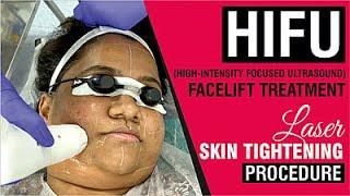 HIFU Facelift Treatment  Laser Skin Tightening Procedure  Sakhiya Skin Clinic