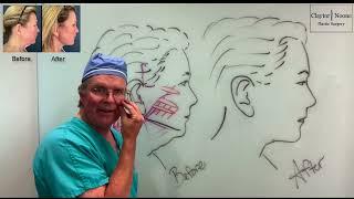 SMAS vs Deep Plane Facelift What You Need to Know  Philadelphia Facelift Surgeon Dr. Claytor