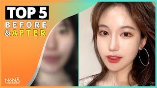 SUB TOP 5 Facial Plastic Surgery Before and After  NANA Plastic Surgery Hospital in Korea