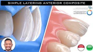 Simple Layering Anterior Composite PPT + Live Demo Class IV - SSRD April 2020