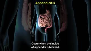 What is Appendicitis