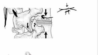 Why Facet Joint Pain Hurts So Bad